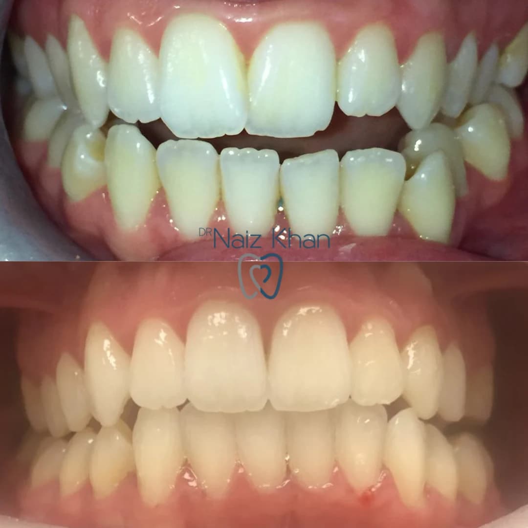 Invisalign patient smile result 1