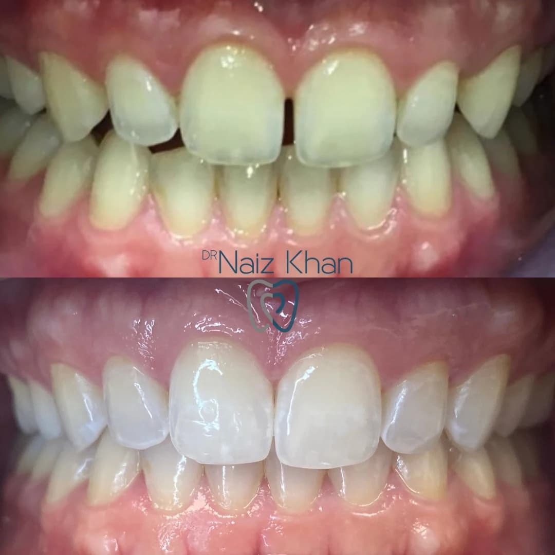 Invisalign patient smile result 3