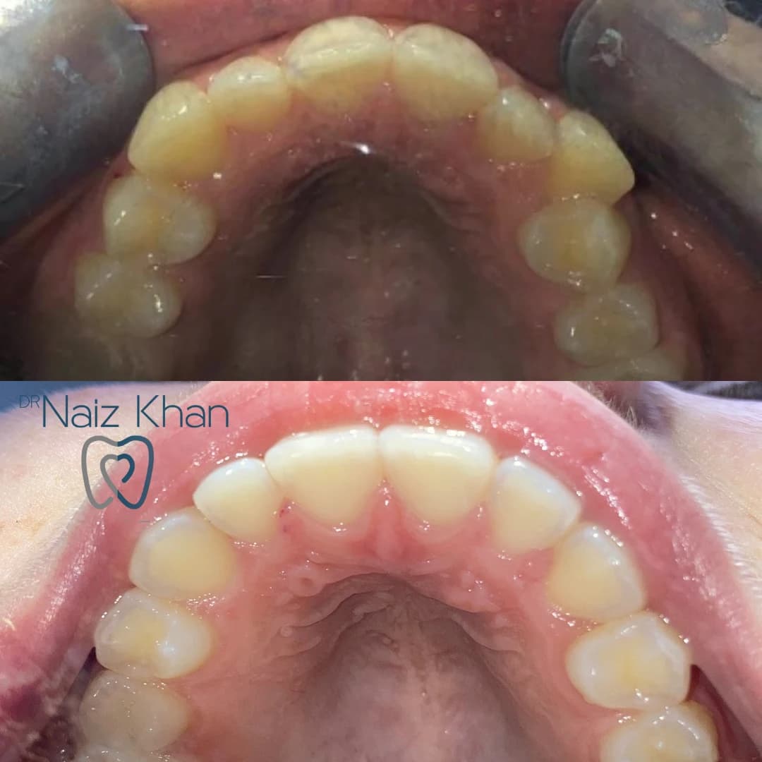 Invisalign patient smile result 4