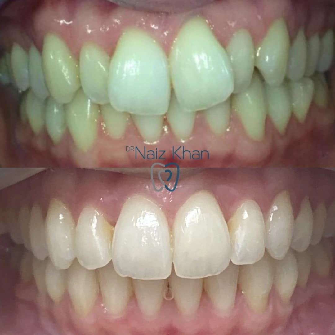Invisalign patient smile result 5
