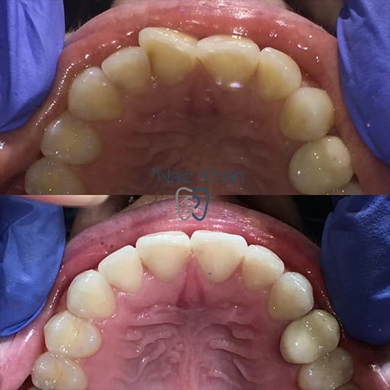 Invisalign patient smile result 6
