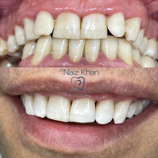 Invisalign patient smile result 7