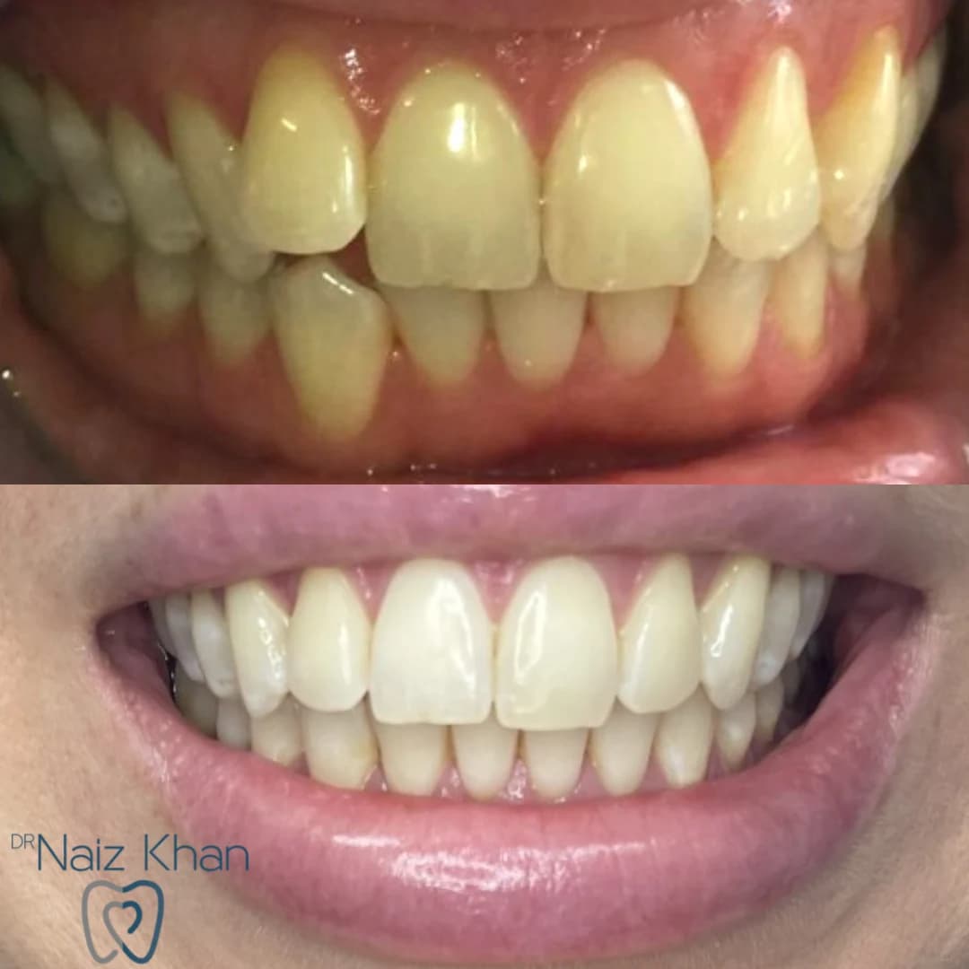 Invisalign patient smile result 8