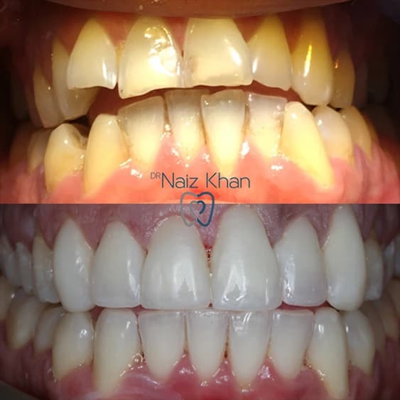 Invisalign patient smile result 9