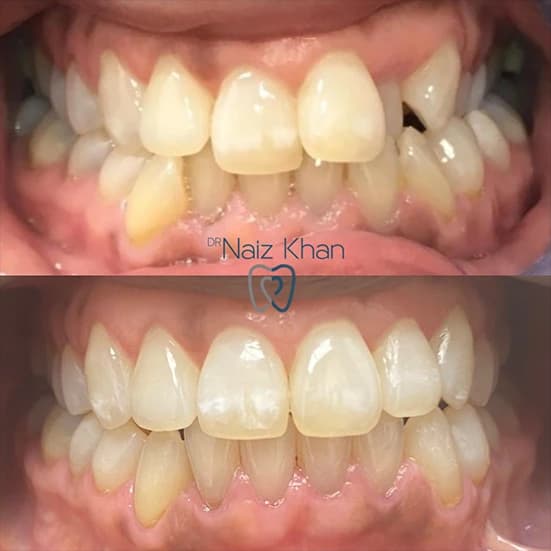 Invisalign patient smile result 10
