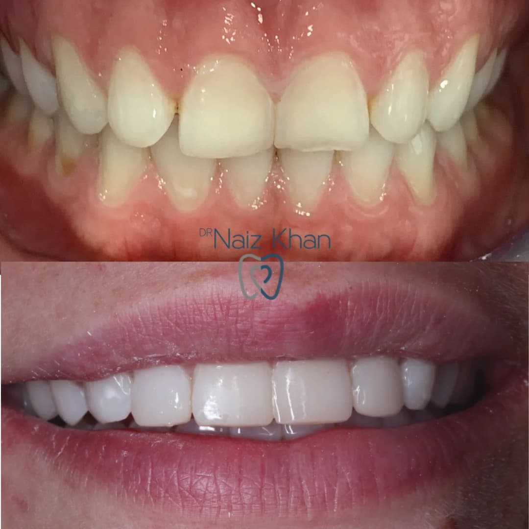 Invisalign patient smile result 11