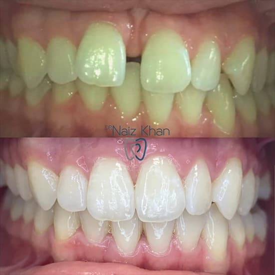 Invisalign patient smile result 2