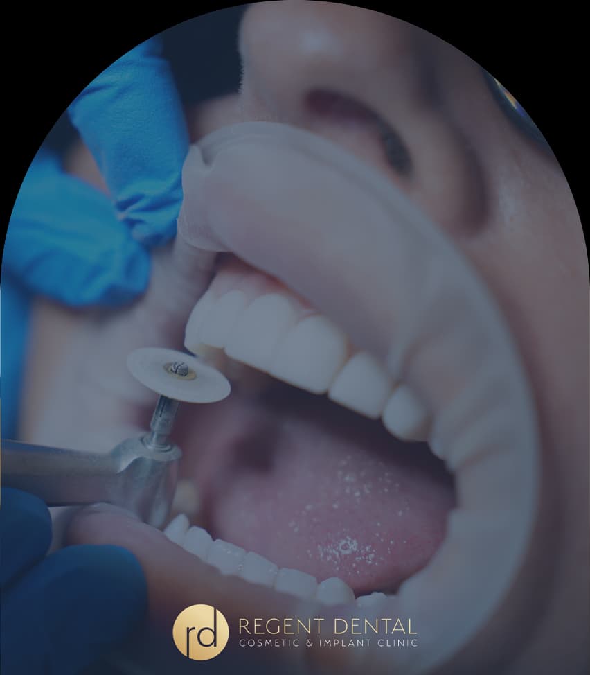 Composite bonding treatment being carried out on a front tooth