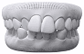 Crowded Teeth