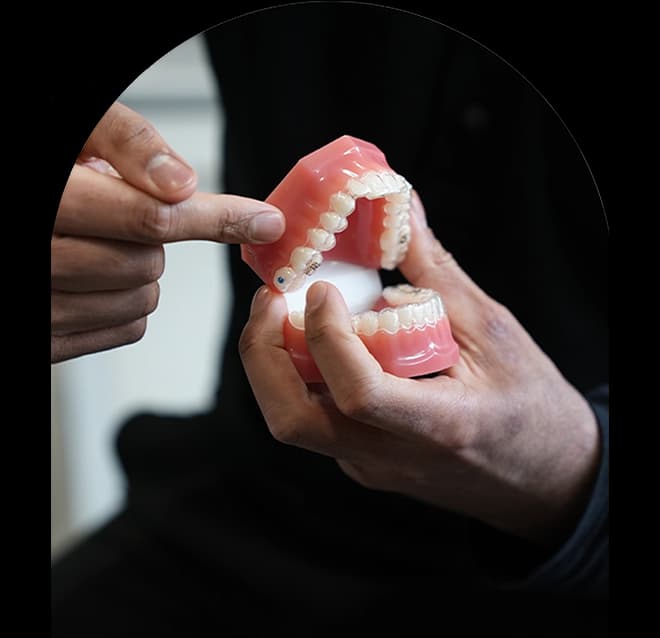 Clear aligner treatment being explained using a dental model