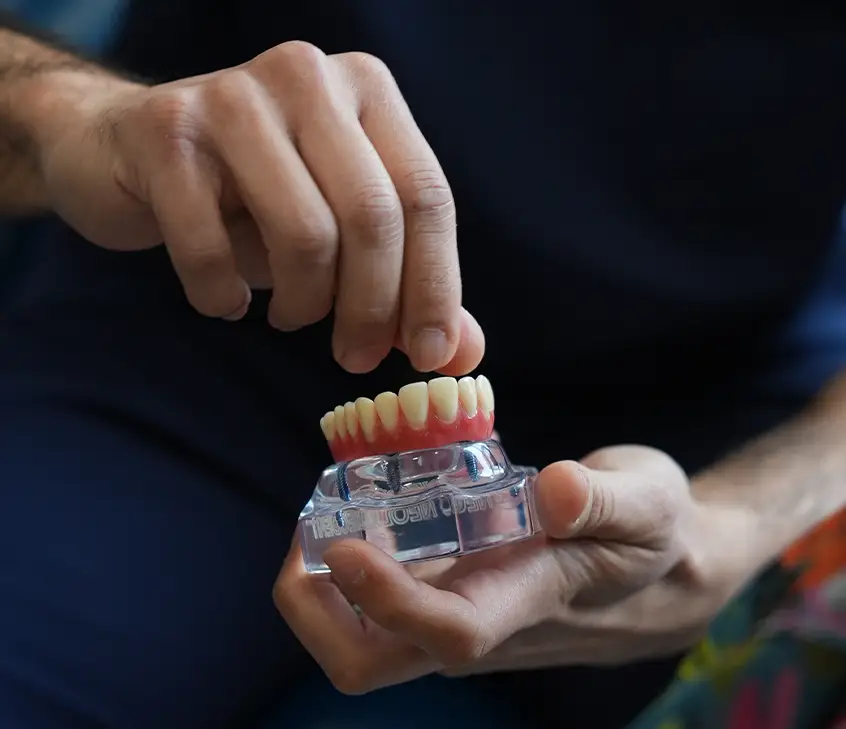 Dental Implants
