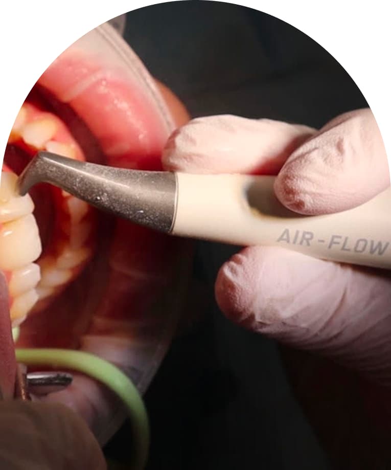Dental hygiene cleaning being carried out with an AirFlow handpiece