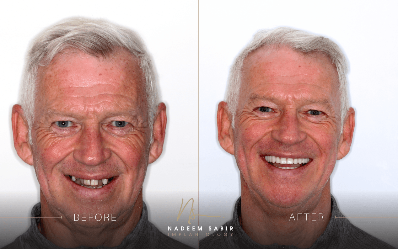 Before and after photos of an older man showing missing teeth restored with dental implants, by Nadeem Sabir Implantology.