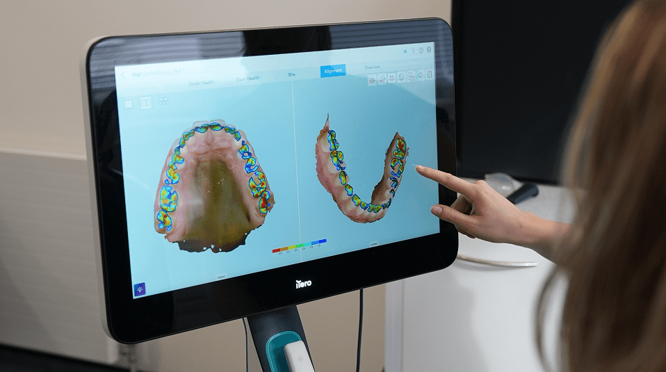 Digital implant scan used for single tooth planning