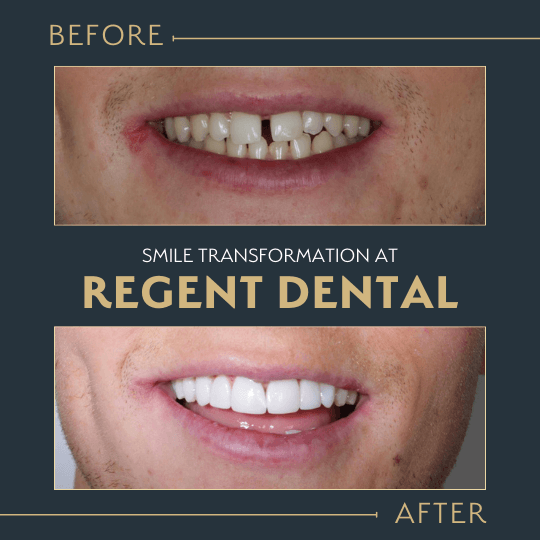 smile transformation at Regent Dental Care