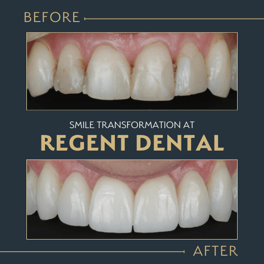 smile transformation at Regent Dental Care