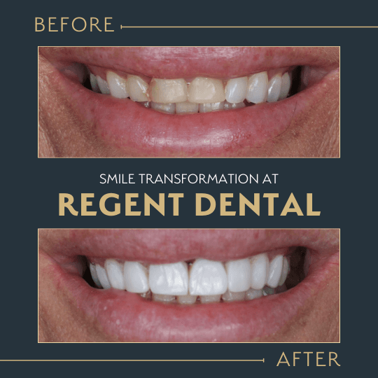 smile transformation at Regent Dental Care