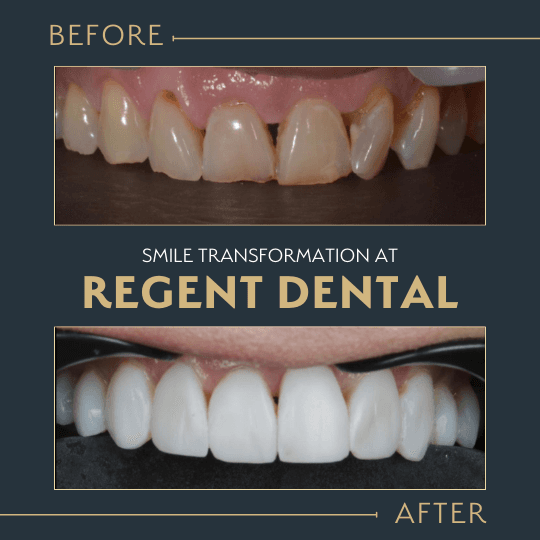 smile transformation at Regent Dental Care
