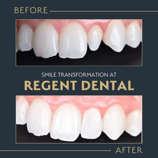 smile transformation at Regent Dental Care