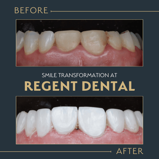 Invisalign case result showing changes in tooth positioning and alignment