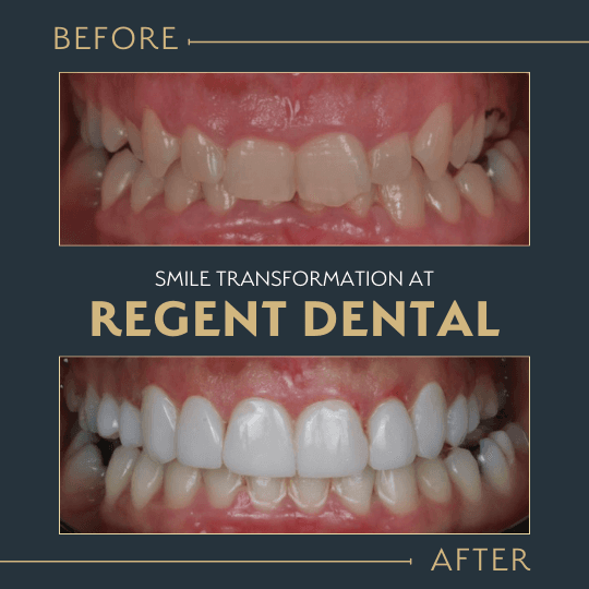 Invisalign treatment results showing improved smile and dental alignment