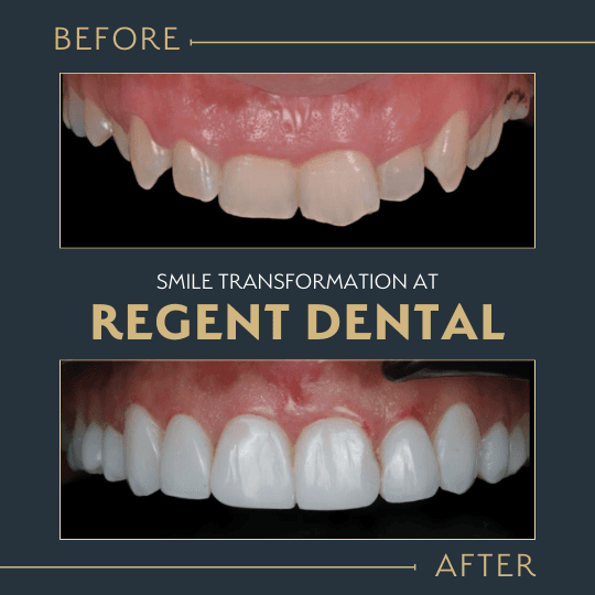 smile transformation at Regent Dental Care