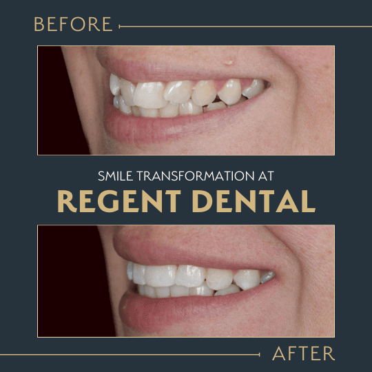 smile transformation at Regent Dental Care