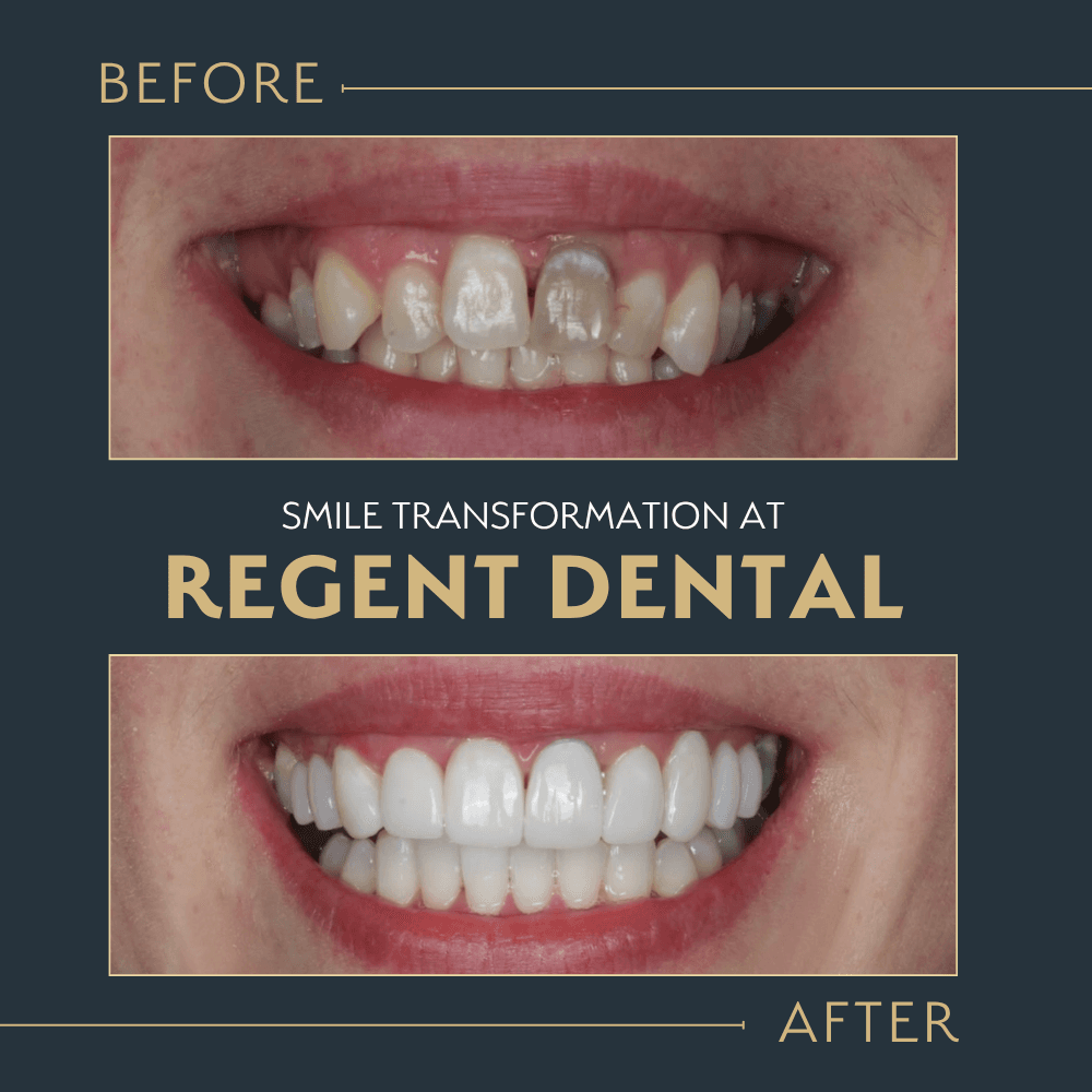 smile transformation at Regent Dental Care