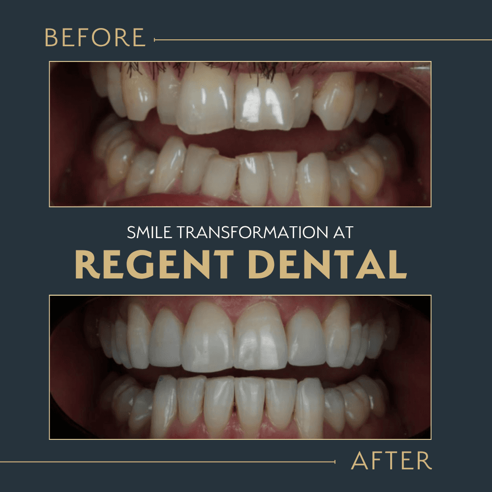 smile transformation at Regent Dental Care