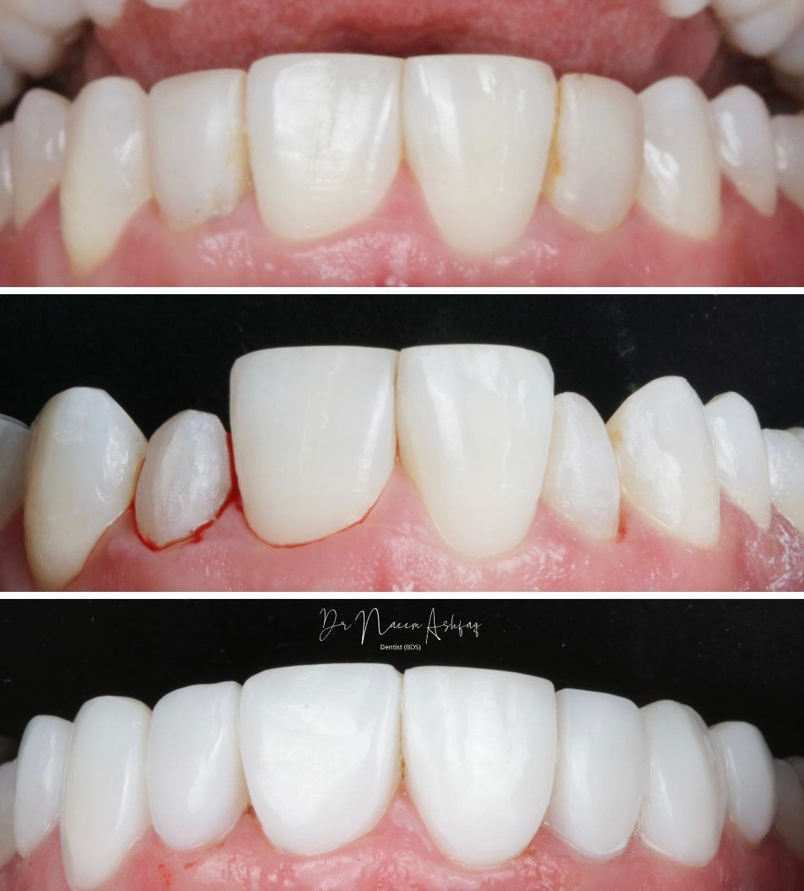 Composite bonding patient smile result 1