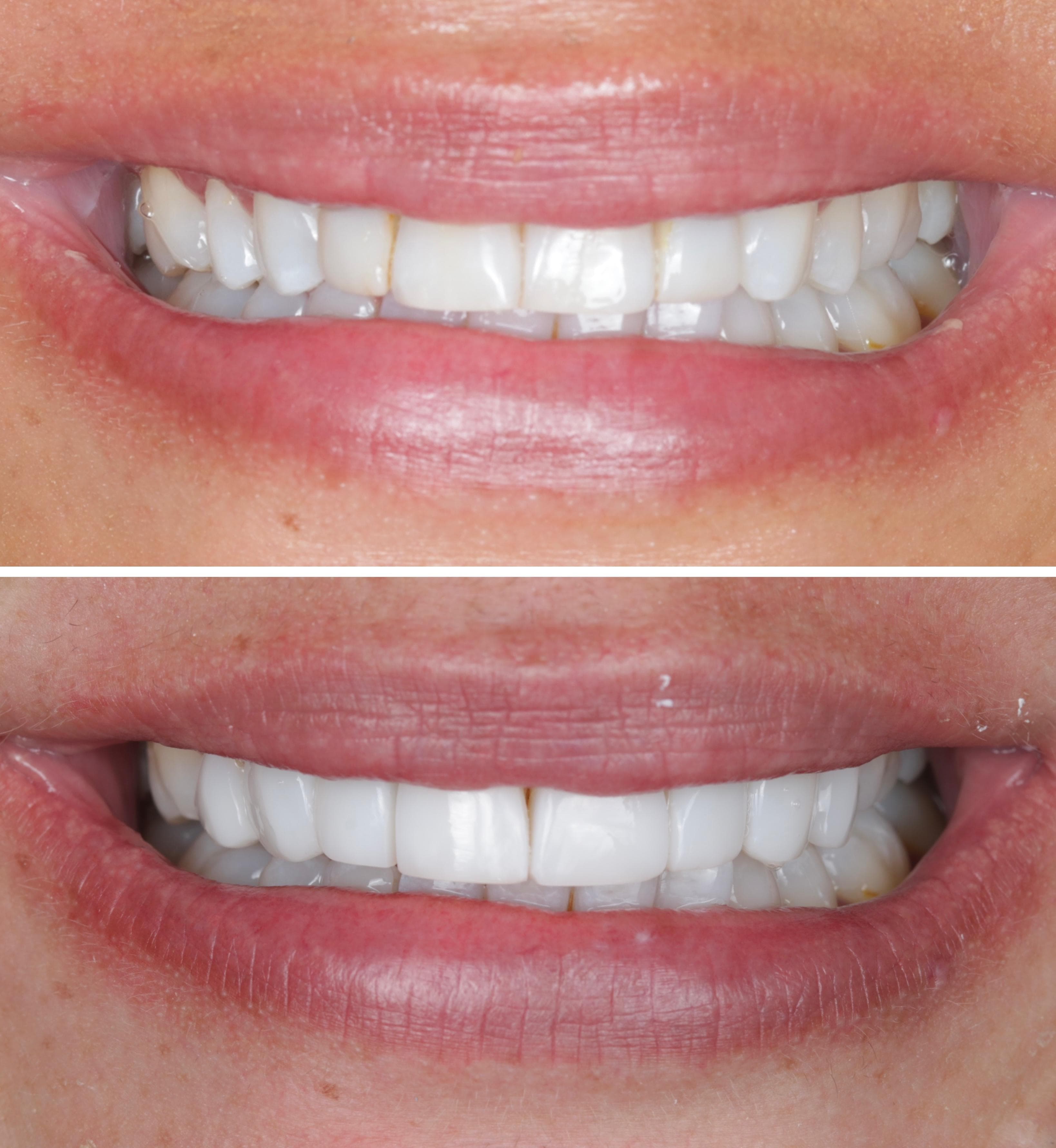 Composite bonding patient smile result 2