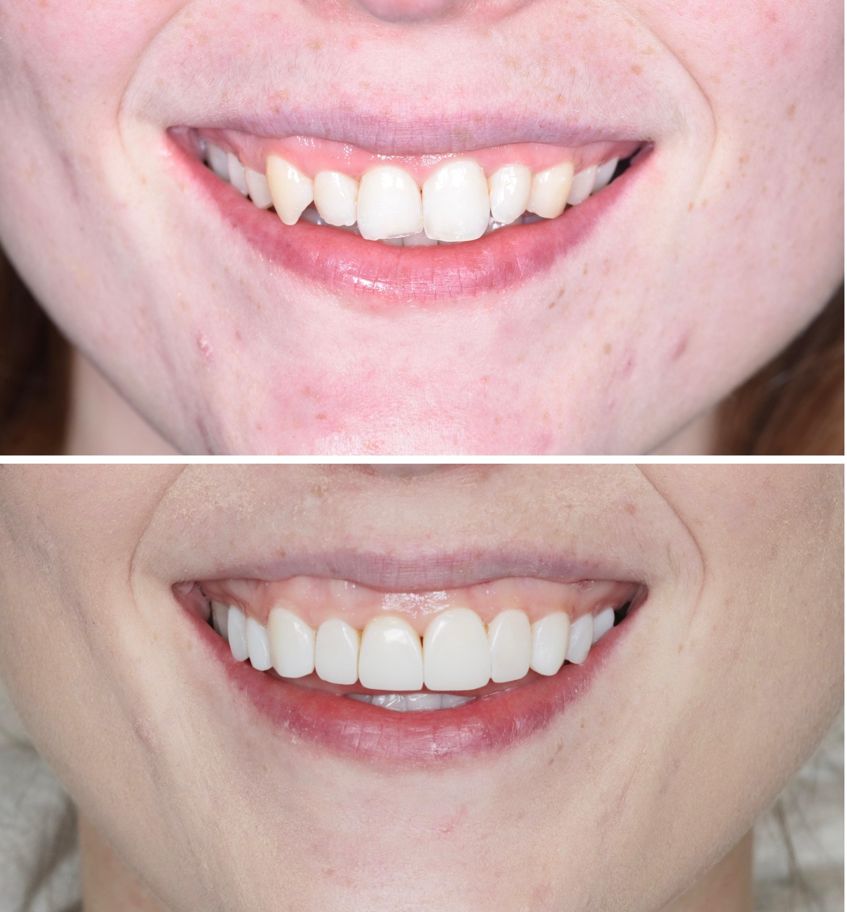 Composite bonding patient smile result 3