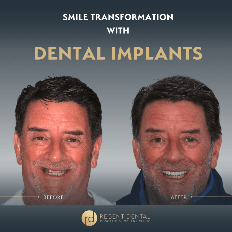 Before and after view of teeth following Invisalign orthodontic treatment