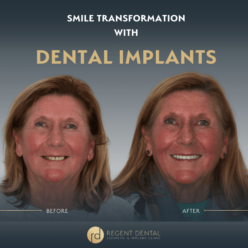 smile transformation at Regent Dental Care