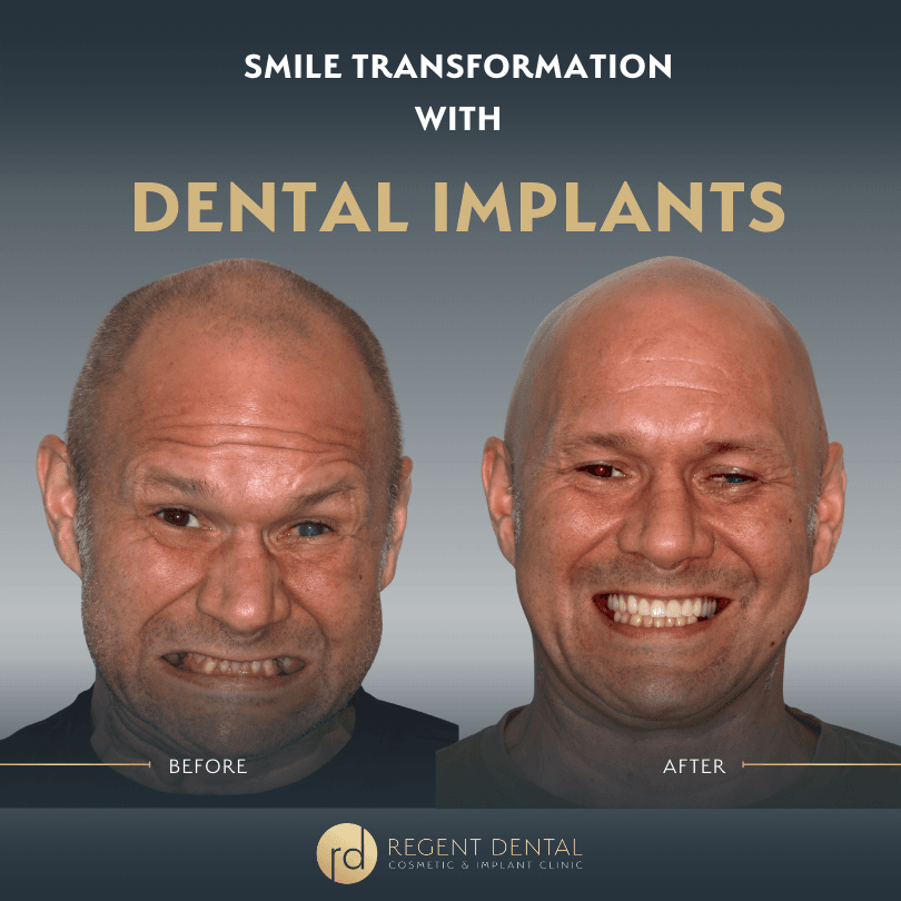 smile transformation at Regent Dental Care