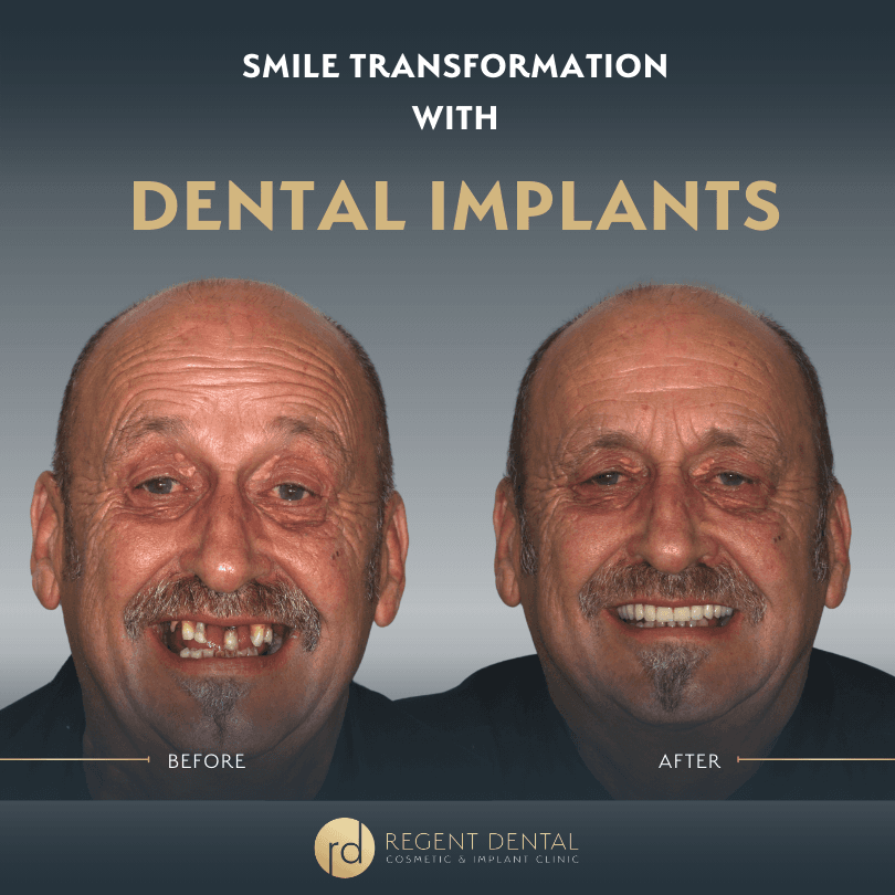 smile transformation at Regent Dental Care