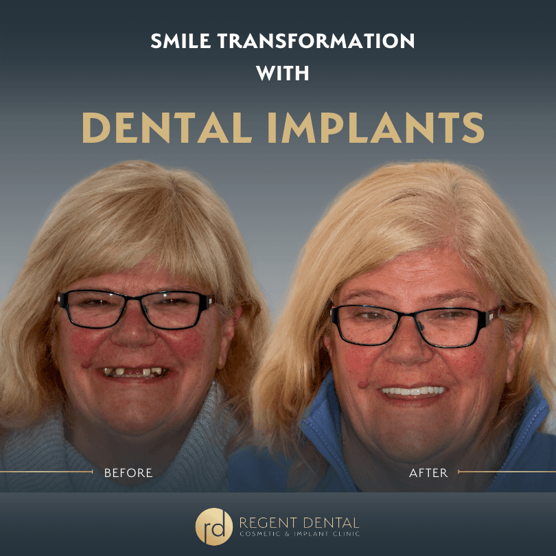 smile transformation at Regent Dental Care