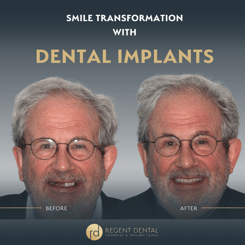 smile transformation at Regent Dental Care
