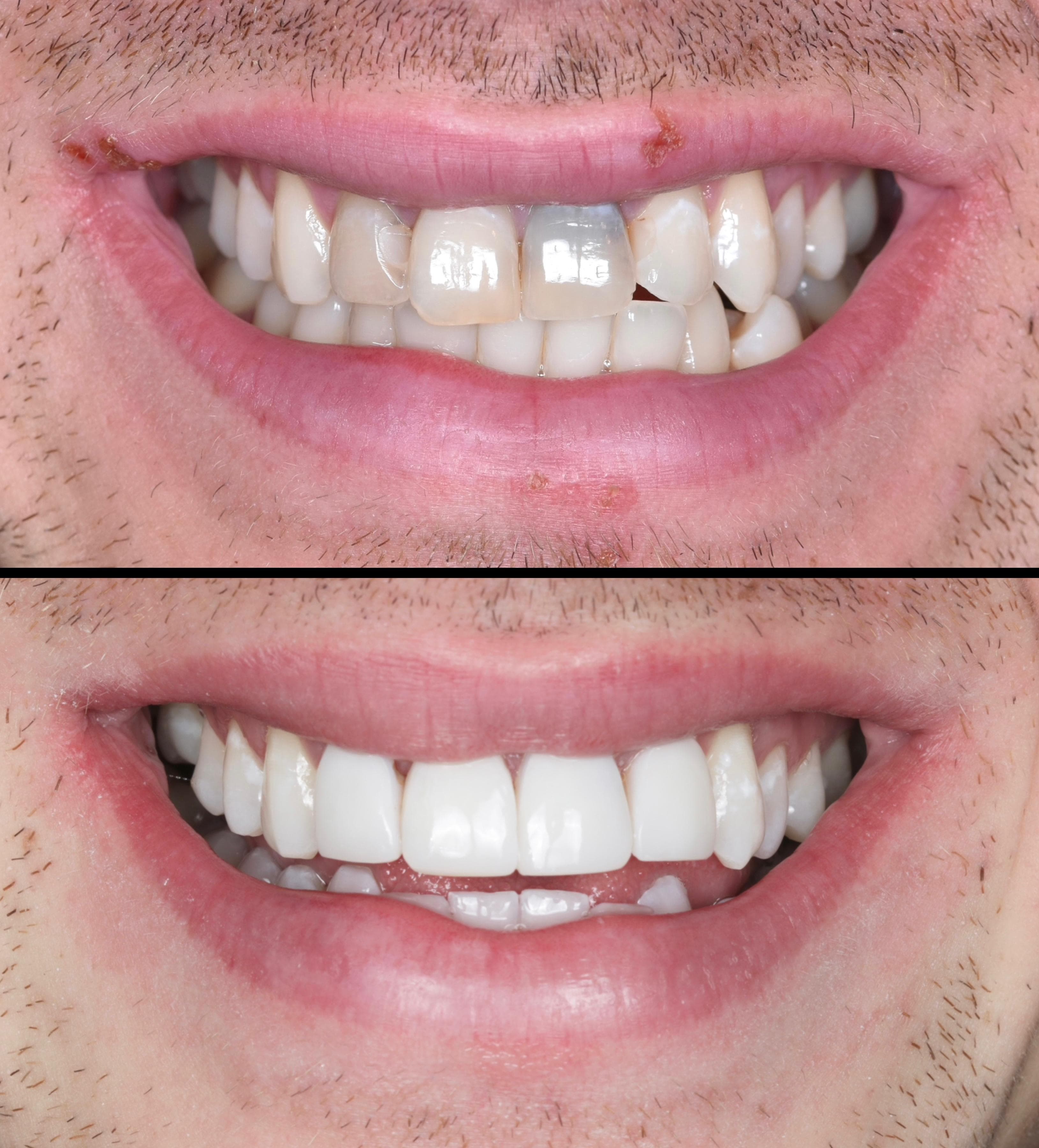 Composite bonding patient smile result 4