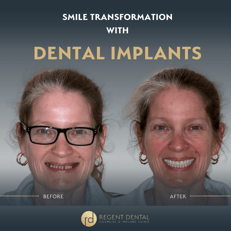 smile transformation at Regent Dental Care