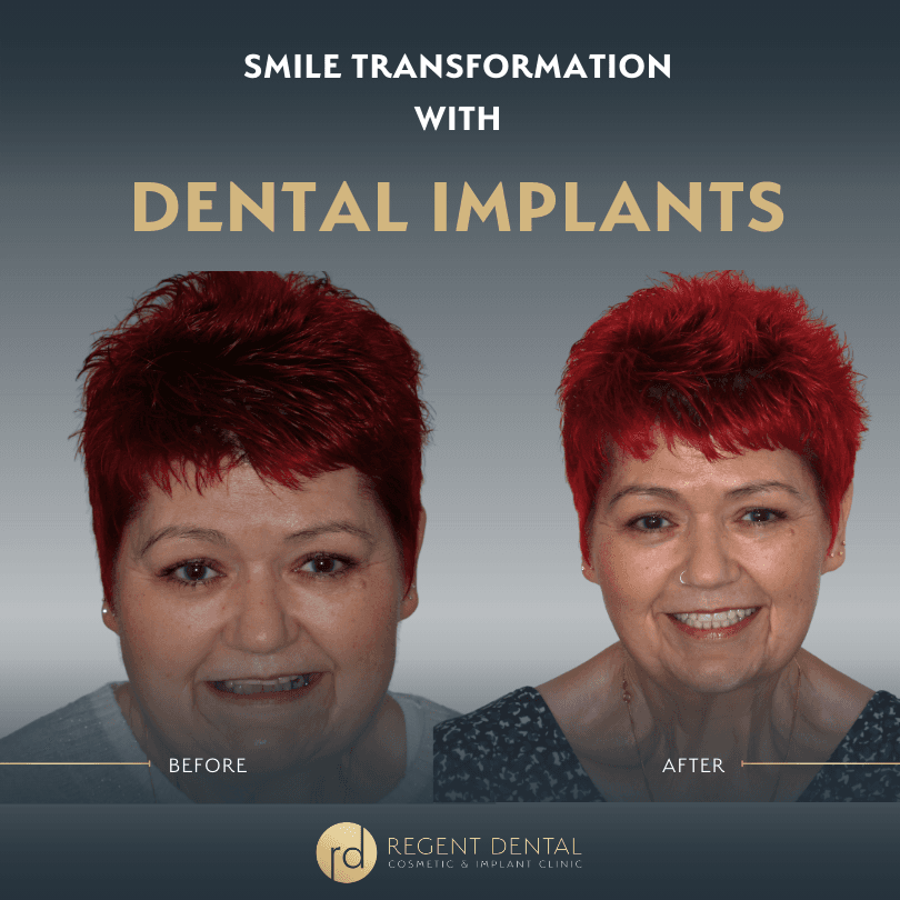 smile transformation at Regent Dental Care