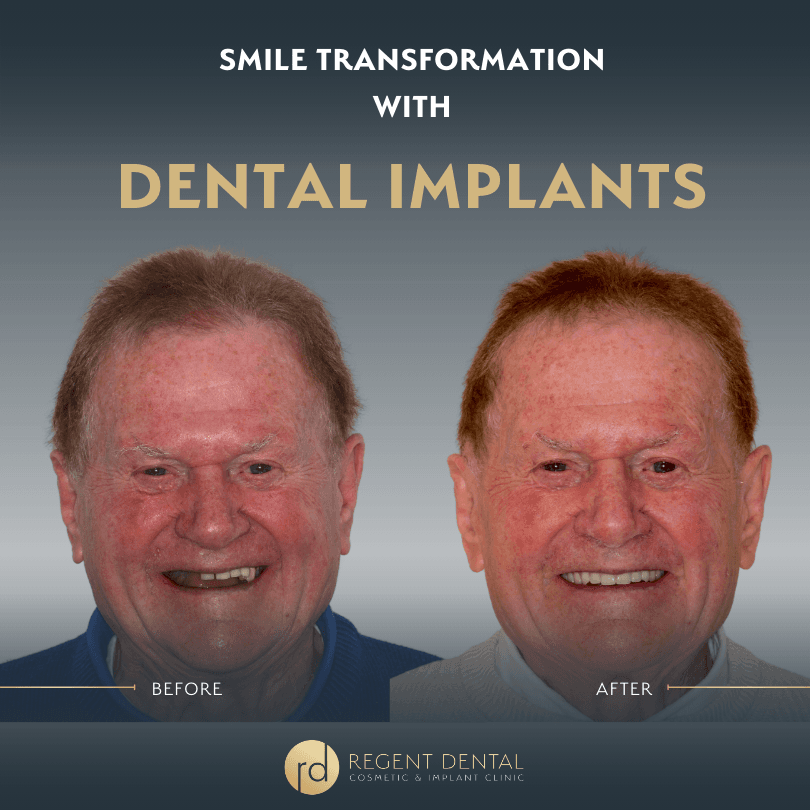 smile transformation at Regent Dental Care