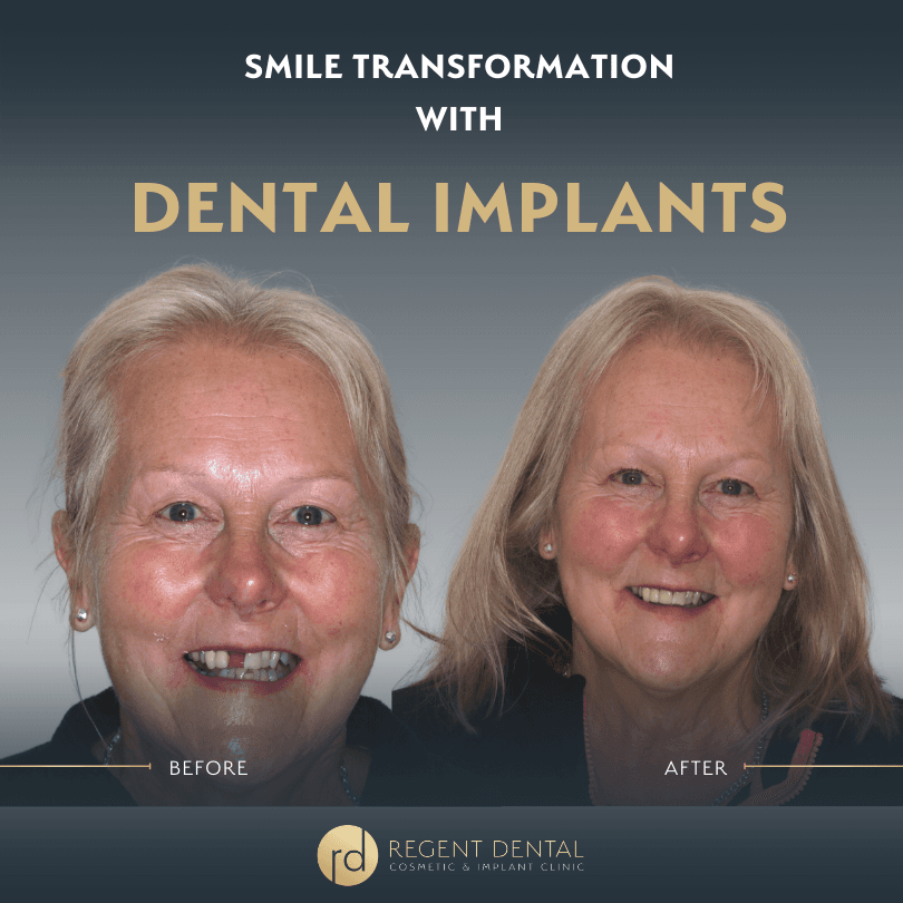 smile transformation at Regent Dental Care