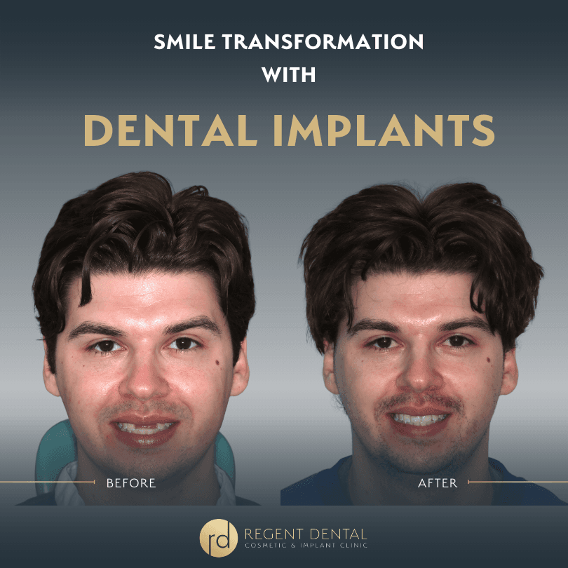 smile transformation at Regent Dental Care
