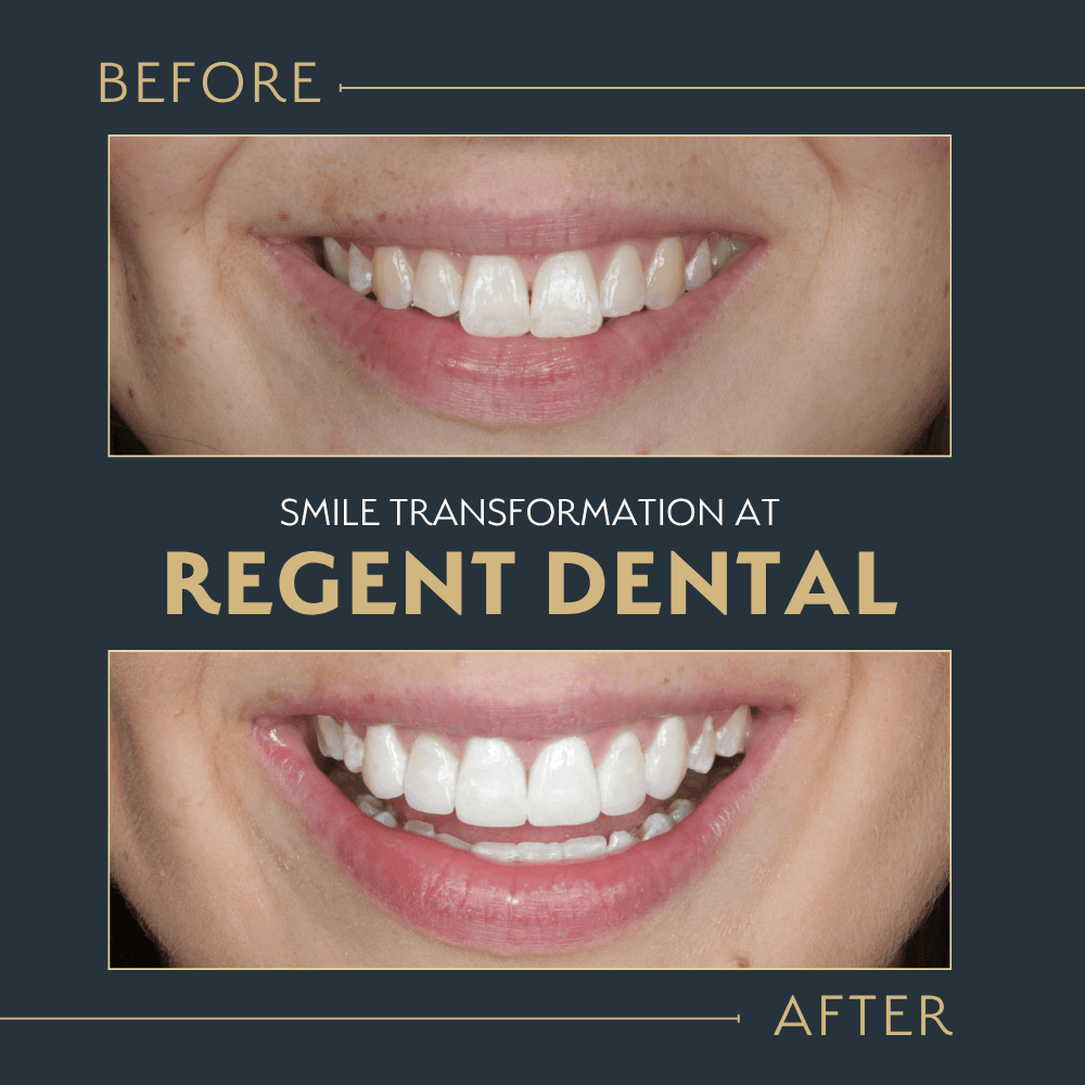smile transformation at Regent Dental Care
