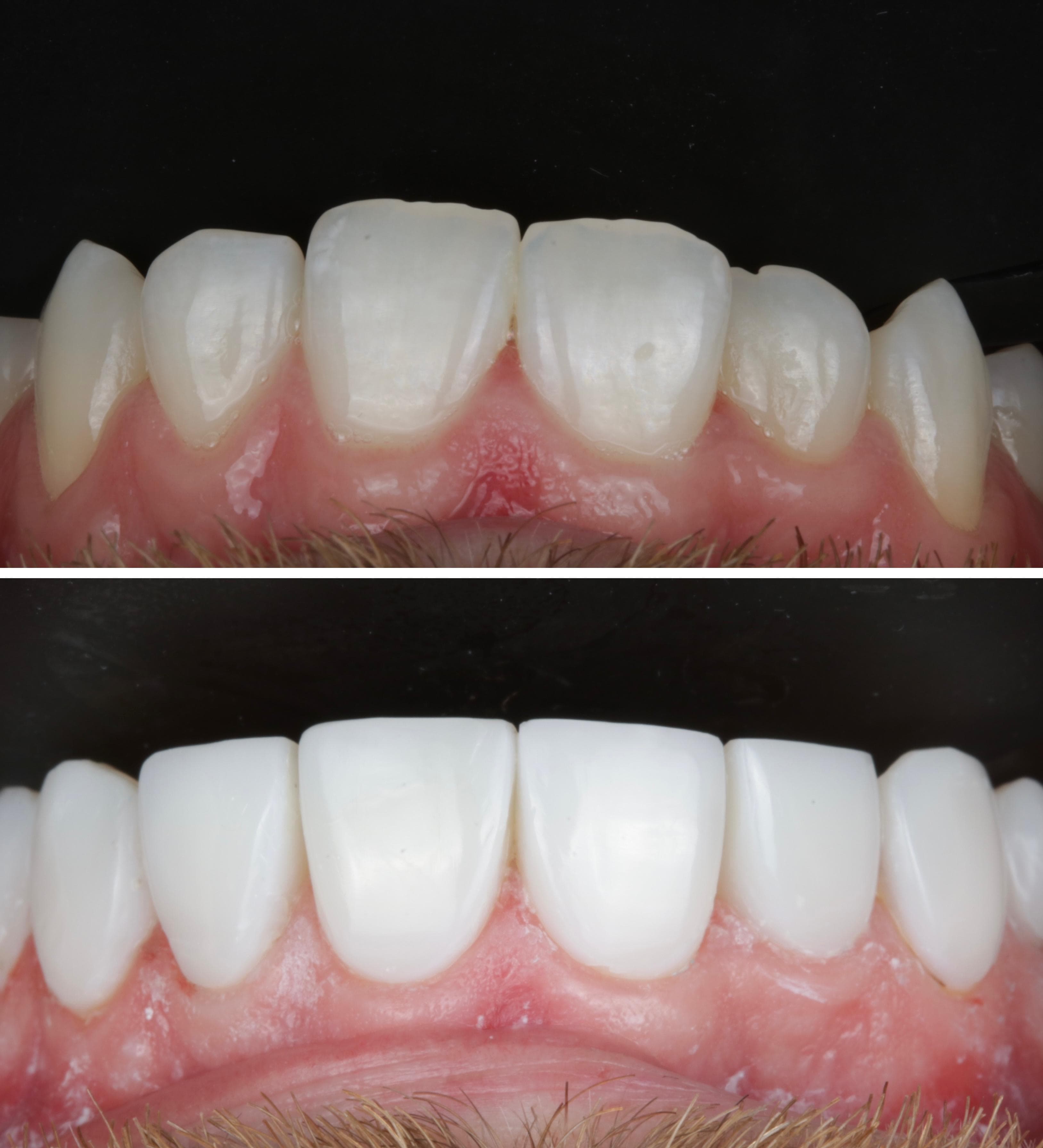 Composite bonding patient smile result 5