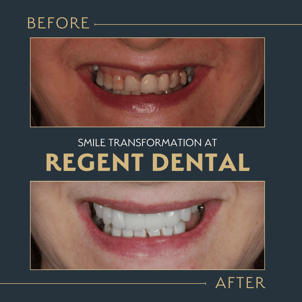 smile transformation at Regent Dental Care