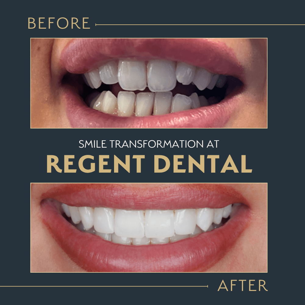 smile transformation at Regent Dental Care