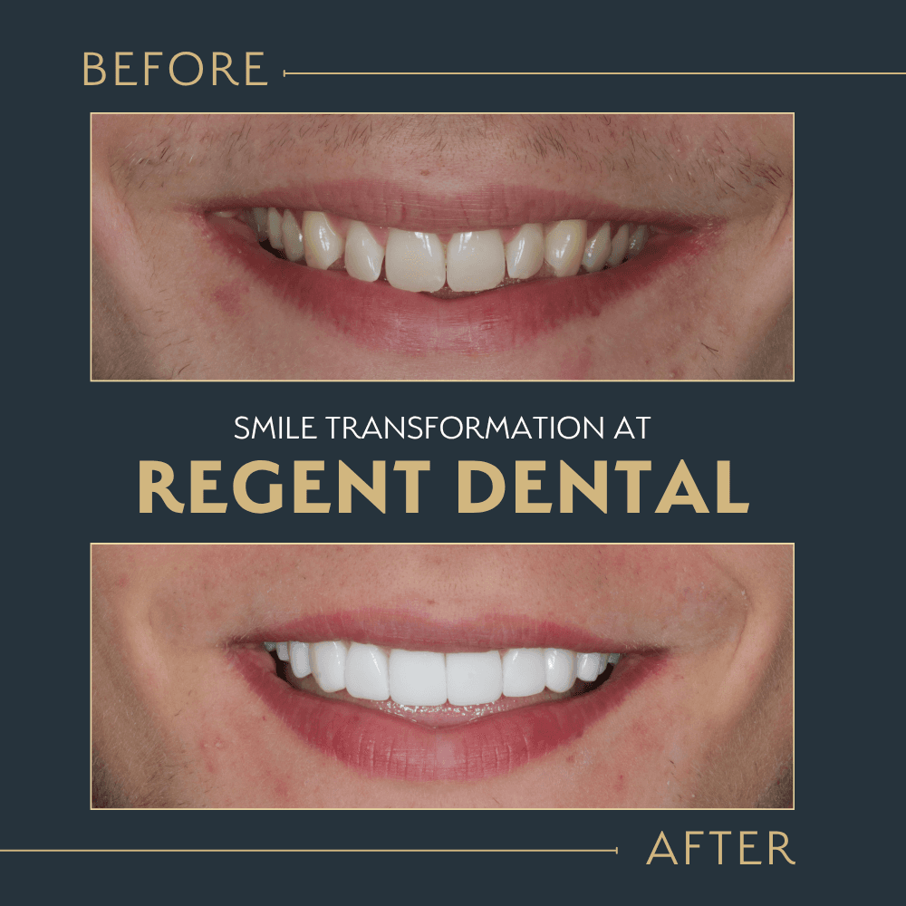 smile transformation at Regent Dental Care
