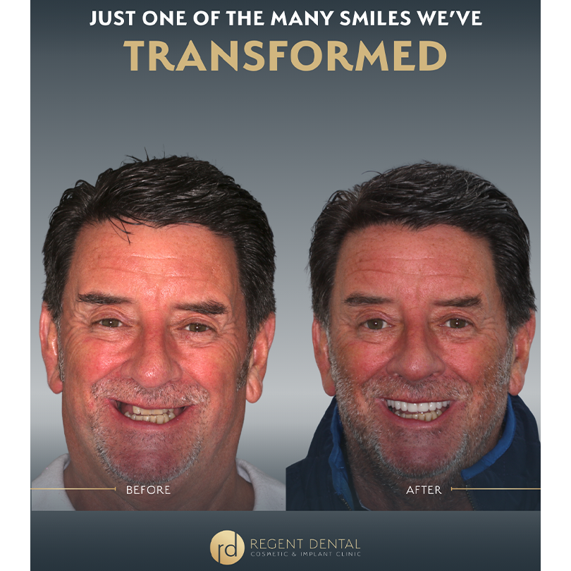 Same day smile full arch implant patient result 2